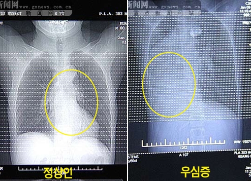 심장이 오른쪽에?…장기 위치 뒤바뀐 中소년