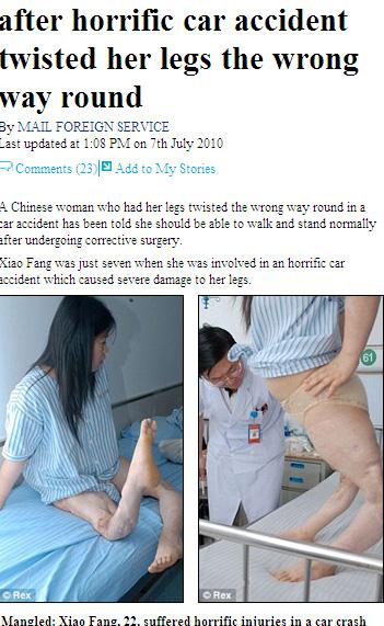 무릎관절이 반대로 다리 꺾인女 충격
