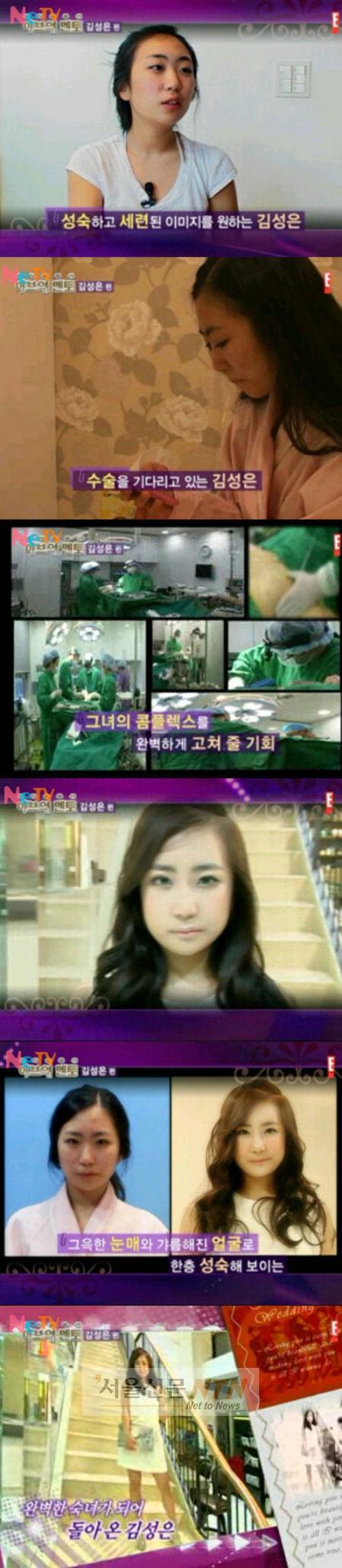 ‘미달이’ 김성은, 성형과정 공개…“글쎄 vs 괜찮다”