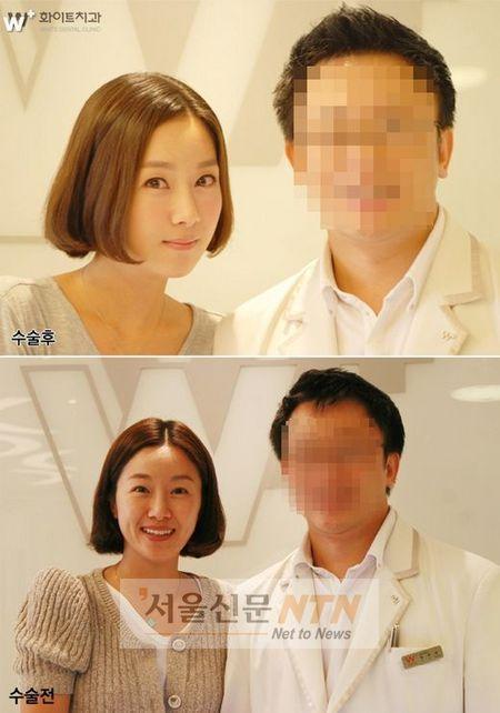 ‘확 달라진’ 김지혜, 양악수술 전후 비교사진…“페이스 오프”