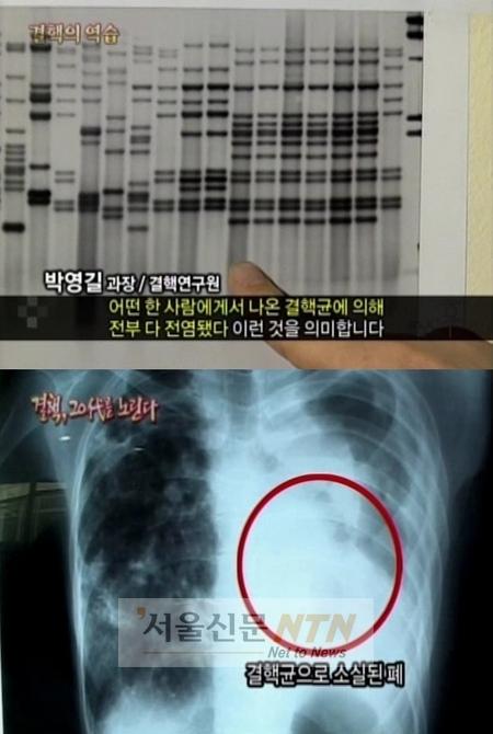 슈퍼결핵 환자 증가, 환절기 감기 유사증상…‘적신호’