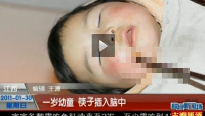 25㎝ 젓가락이 얼굴 관통…2세 여아 충격 사고