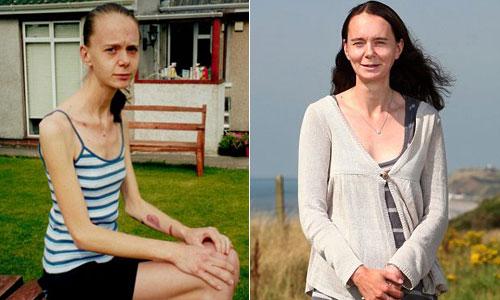 “살고 싶어요” 18년 간 거식증과 싸운 英여성