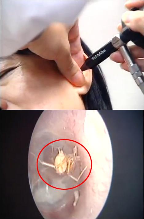 귓속에 살아 있는 ‘거미’가 스멀스멀…