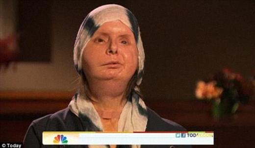 침팬지에 얼굴 잃은 女, ‘새 얼굴’ 최초 공개