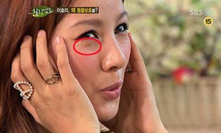 이효리 비립종, 채식 때문이 아니라면 왜?