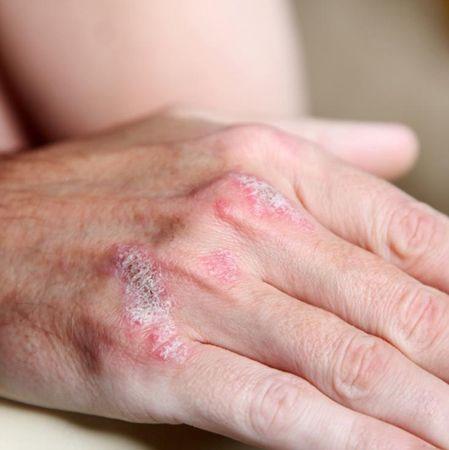 찬바람 불 때 한방으로 들여다본 건선 탈출법