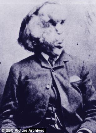 ‘엘리펀트 맨’ 뼈로 암 치료법 찾아 나선다