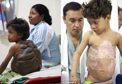 ‘거북이 등껍질’ 가진 소년, 희망의 전도사 되다