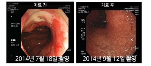 위암 3기, 전절제술 앞둔 40대 남성 “전이 두려워 한방암치료 선택”