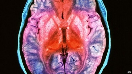 사람 뇌 먹는 부족 유전자로 치매·광우병 비밀 찾다