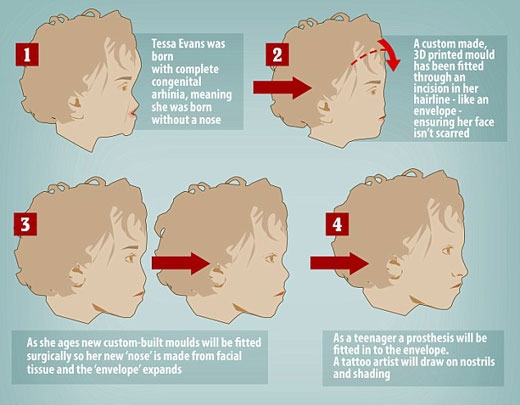 ‘코 없는’ 2살 여아, 3D 프린팅 이식수술 성공