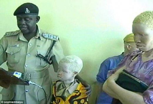 ‘하얀 흑인’ 6살 알비노 소녀 인신매매 직전 극적 구조