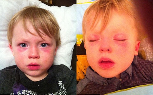 ‘물리 두드러기’ 아시나요?’물 알러지’에 고통받는 소년