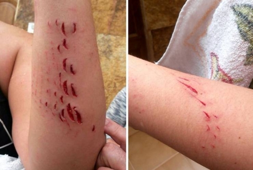 “상어공격 받으면 이렇게 됩니다”