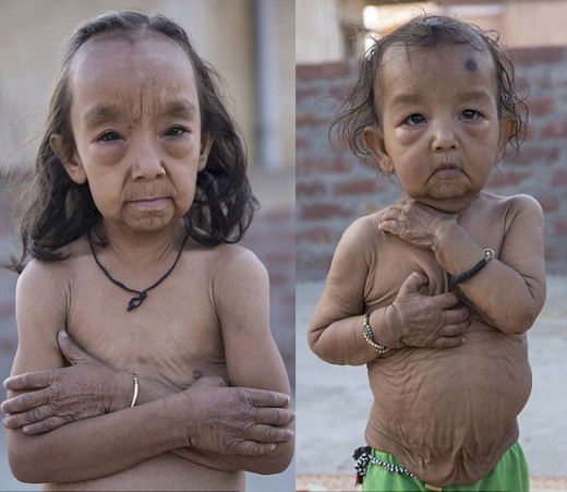 [월드피플+] 태어나자마자 늙어버린 인도 남매 이야기