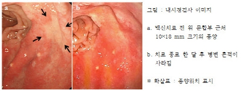 수지상세포 백신이 뭐길래? 위암치료의 대안으로 주목돼