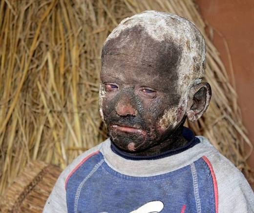 온몸이 돌처럼 굳어가는 희귀병 11살 소년의 희망