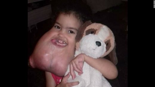 거대한 혹주머니 달고 살던 3살 아기, SNS 통해 새 삶