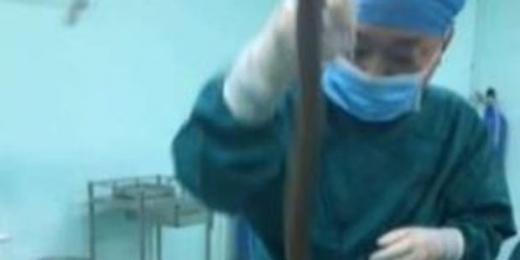 살아 있는 장어 몸 속에 집어넣었다 죽을 뻔한 남자