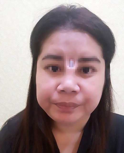 눈과 눈 사이에 실리콘이 툭…값싼 성형수술의 비극