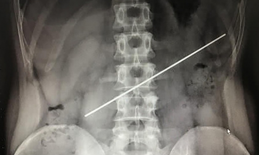 [여기는 중국] 술자리서 85만원 건 위험한 내기…볼펜심 꿀꺽한 男