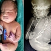다리가 붙어 태어난 ‘인어공주’ 아기…15분 만에 사망