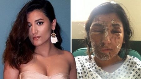 [월드피플+] 염산테러로 얼굴 잃은 20대 女…1년 후 모델로 우뚝