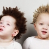 [월드피플+] 흑인 부모에게서 태어난 ‘하얀 피부’의 흑인 쌍둥이