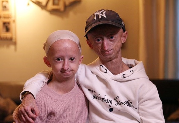 남들보다 10배 빨리 늙은 병… ‘조로증’ 걸린 남매의 사연