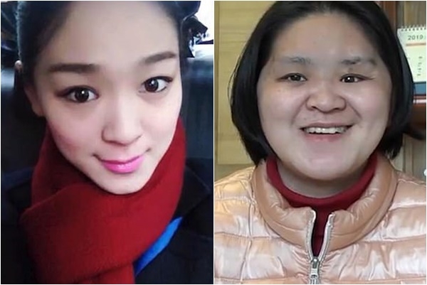 추락사고로 만신창이된 전직 승무원, 3D 기술로 얼굴 재건