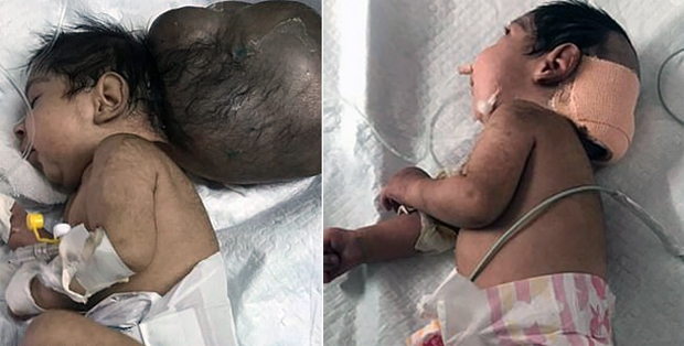 인도서 머리 두 개 달린 아기 생매장하려던 아버지 덜미