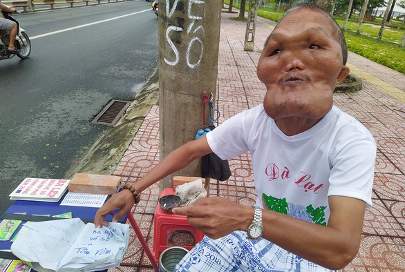 [여기는 베트남] 얼굴은 기형이지만 마음은 ‘천사’…고엽제 피해자의 삶