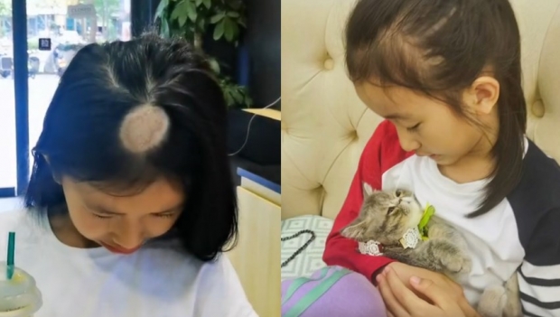 [여기는 중국] 고양이 입양 후 탈모 증세 나타난 中 소녀의 사연