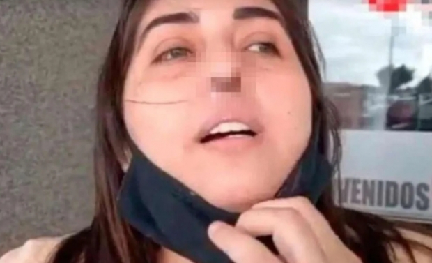 콧구멍 1개뿐인 여자 “PCR검사 받다 이 지경 됐어요”