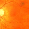 [고든 정의 TECH+] 눈 검사로 심장 질환 위험도 알아내는 인공지능 등장
