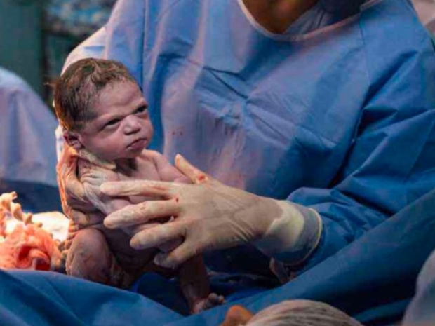 사진 한장에 세계 스타된 ‘화난 신생아’... 2년 후 모습도 찍혔다