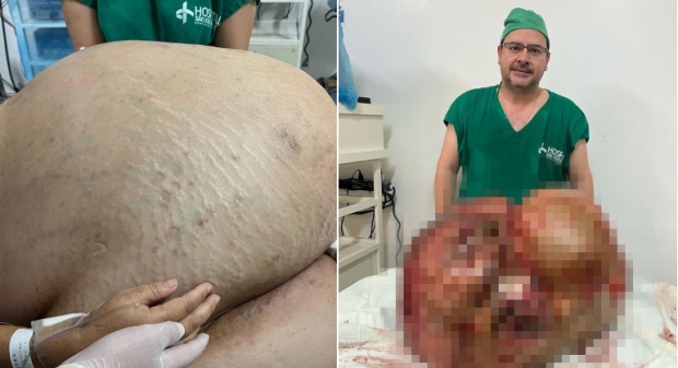 무게 46kg 초대형 종양…여자의 배를 가득 채우고 있었다