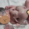 ‘기생 쌍둥이’ 달고 태어난 아기…목숨 건 분리 수술 성공 [여기는 중국]