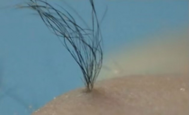 탈모, 과학으로 치료할까?…모낭, 줄기세포로 만들어