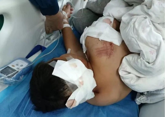 목줄없는 대형견에 中초등생 또 물려…‘안락사’ 조치