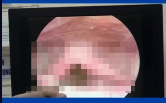 야생 풀 씹었다가 목 안에 기생하는 거머리 발견한 남성 [여기는 동남아]