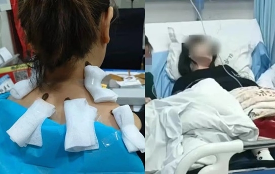 거머리로 목 디스크 흡혈 치료?…‘세균 감염’된 中 여성 [여기는 중국]