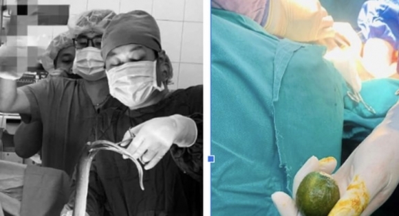 복통 호소한 남성 뱃속에서 길이 65㎝ 장어가 ‘꿈틀’ [여기는 동남아]