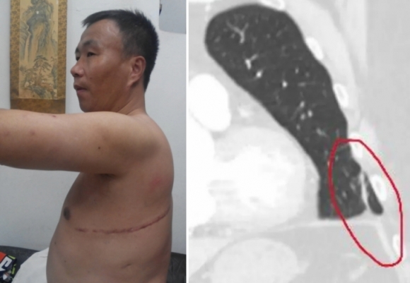“中정부가 강제 장기적출” 생존자 충격 폭로…“감옥서 간·폐 사라져”[핫이슈]