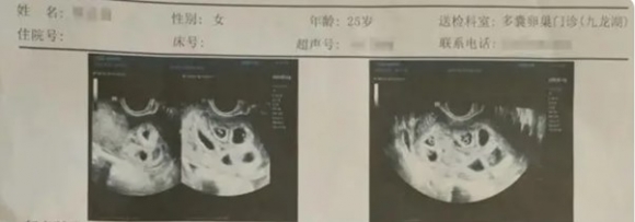 中 배란 촉진제 맞고 ‘아홉 쌍둥이’ 임신한 여성…역대 최다 기록 [여기는 중국]