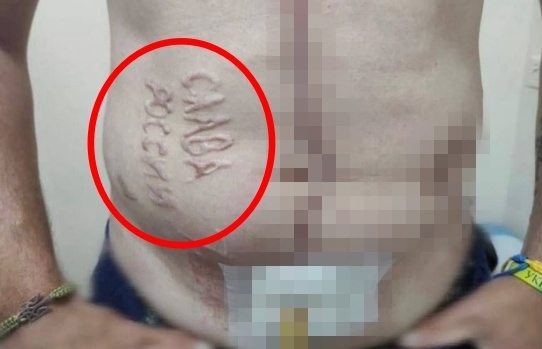 우크라 포로 몸에 새겨진 충격적 문구…“러시아군의 고문·학대 증거”