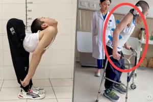 “세계 최초”…허리 180도 꺾인 중국 청년, 똑바로 서는 