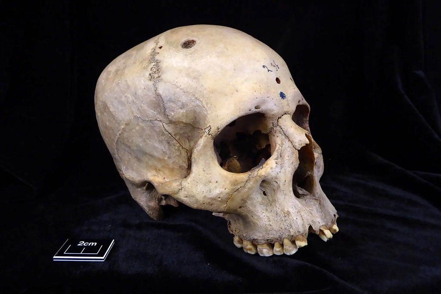 기원전 2686년에서 2345년 사이 30~35세 남성의 두개골에서 전이된 뇌암으로 인한 수십 개의 병변을 둘러싼 두개골 가장자리에 절단 자국이 있는 것으로 밝혀졌다. 사진=Tondini, Isidro, Camarós, 2024