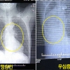심장이 오른쪽에?…장기 위치 뒤바뀐 中소년